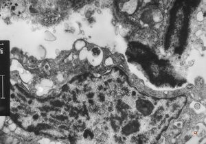 M,66y. | follicular cyst with hyaline Rushton bodies M,66y. | follicular cyst with hyaline Rushton bodies